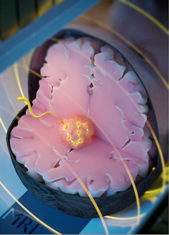 &OpenCurlyDoubleQuote;磁性種子&rdquo;可以被引導到癌症組織中 然後用熱量破壞它