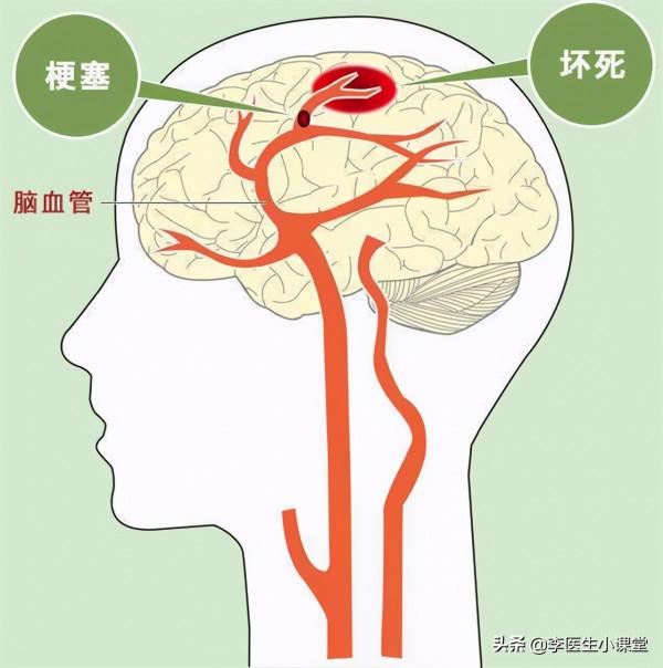 腦梗死越來越多,哈佛大學醫學院:堅持做到這5件事,遠離腦梗 腦梗死越來越多,哈佛大學醫學院:堅持做到這5件事,遠離腦梗