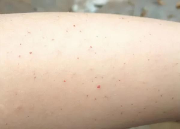 身上出現很多小紅點，像小紅痣，不痛不癢是怎麼回事？