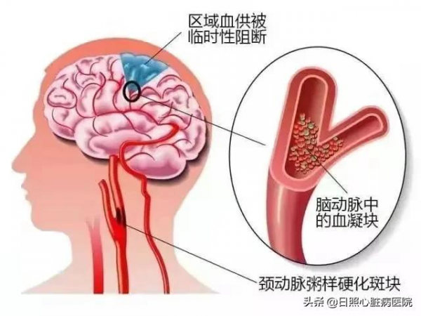 &OpenCurlyDoubleQuote;術&rdquo;手有策，腦科中心球囊擴張&OpenCurlyDoubleQuote;生命線&rdquo;解決反覆頭暈