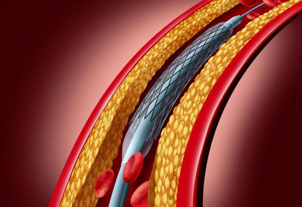 血管中有血栓時，晚上睡覺會經常出現4個症狀，若你有，及時檢查