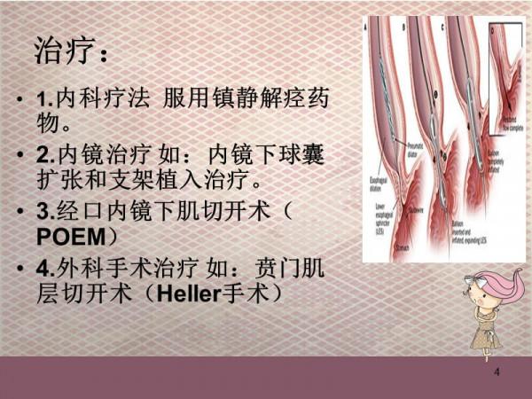 什麼是賁門失弛緩症？