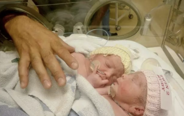 兩個大腦指揮一個身軀,真的能保證不吵架嗎?連體嬰生活大揭秘 兩個大腦指揮一個身軀,真的能保證不吵架嗎?連體嬰生活大揭秘