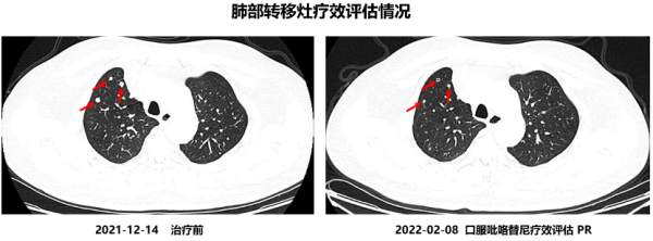 晚期HER2突變肺腺癌：後線吡咯替尼療效神奇