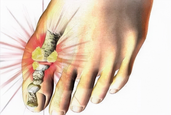 痛風不痛就是病好了嗎？這3個降尿酸的方法，可能比吃藥都有效