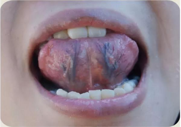 血瘀生百病，一張圖辨別自己是不是血瘀體質