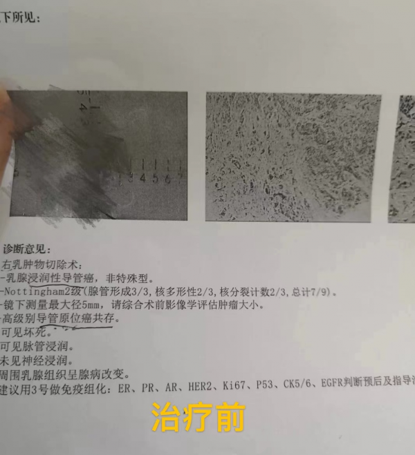 來自小梁的自述：乳腺癌毀掉了我的家庭