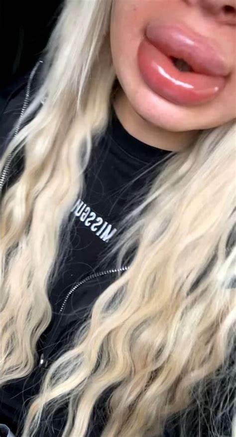 英國24歲女子第一次豐唇腫成&OpenCurlyDoubleQuote;香腸嘴&rdquo;，填充物膨脹到原來的20倍